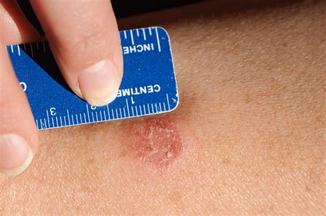 How Long Does Ringworm Take To Heal Canhavetoday