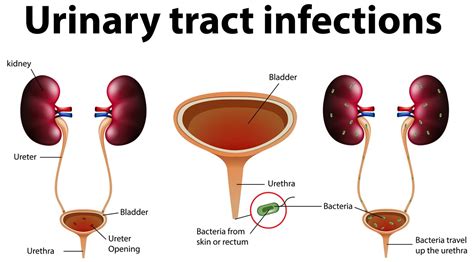 Urinary Tract Infections Symptoms Diagnosis And Treatment Urinary