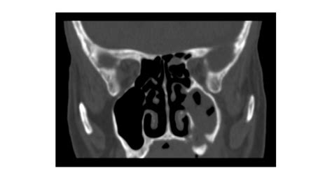 Osteonecrosis Mandibular Relacionada Con M Ltiples F Rmacos En Un