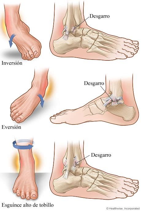 Que Es Un Esguince De Tobillo Grado Y Esguince De Tobillo Porn Sexiz Pix