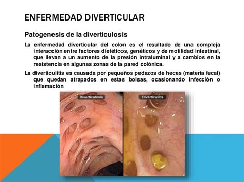 Enfermedad Diverticular