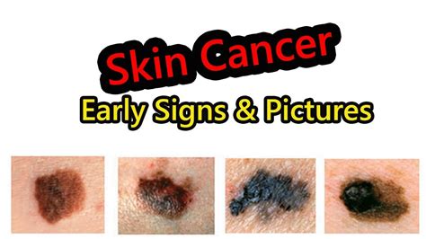 Melanoma Skin Cancer Symptoms And Signs