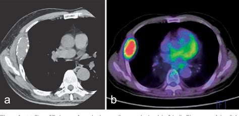 Figure 1 From A Case Of Primary Lung Cancer With Synchronous Costal