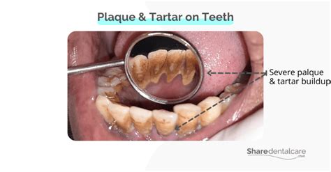 Severe Plaque on Teeth - Share Dental Care