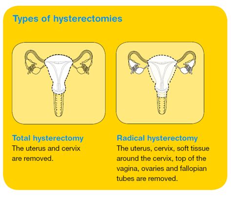 Hysterectomy Meaning 