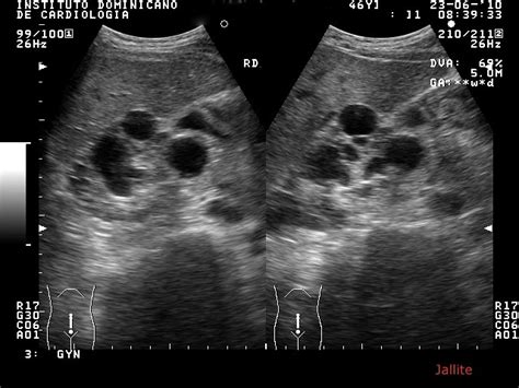 Riñones Poliquisticos And Irc And Quiste Ovario Hemorragico