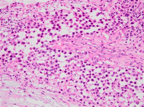 Pathology Outlines Clear Cell Sarcoma Of Soft Tissue