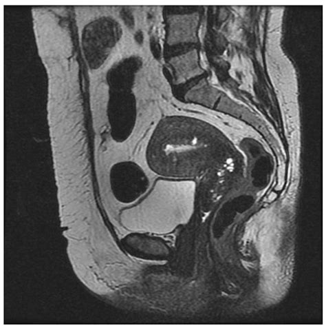 Mri And Adenomyosis What Can Radiologists Evaluate