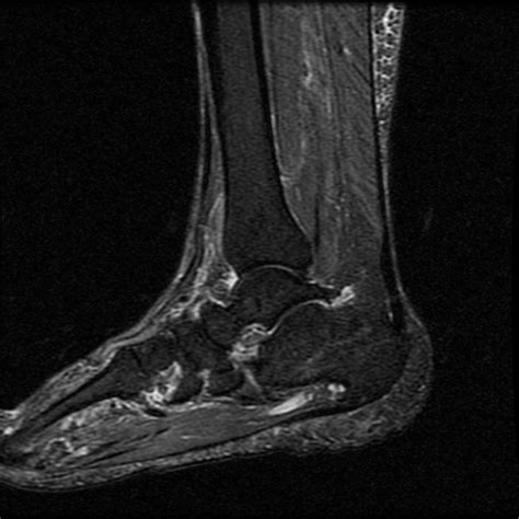 Posterior Tibial Tendon Mri Porn Sex Picture