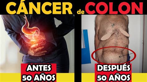 Signos Del C Ncer De Colon Antes Y Despu S De Los A Os S Ntomas