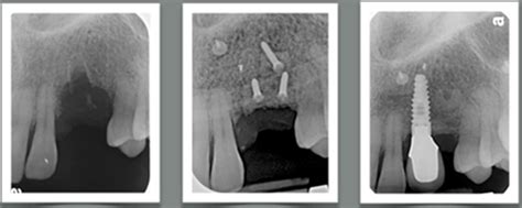 Bone Graft | Bone Regeneration | Implant & Sedation Dentistry | Perth