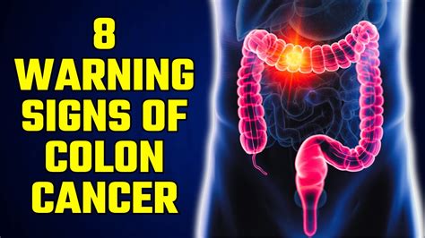 Critical Colon Cancer Symptoms You Should Never Ignore Youtube