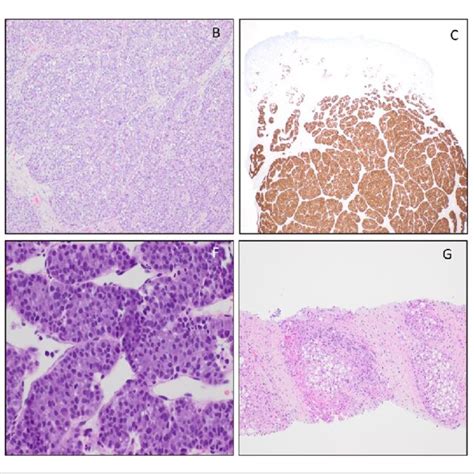 A Ulcerated Hard Palate Metastatic Tumor Hematoxylin Eosin 40×