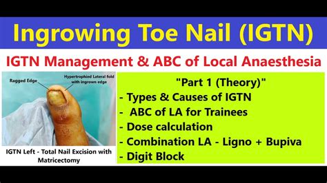 How To Give Local Anesthesia Digit Block Ingrown Toenail Igtn