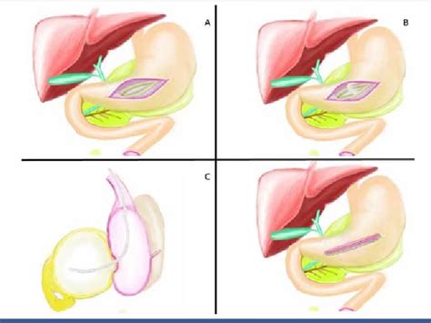 Figure 3 From Laparoscopic Anterior Transgastric Cystogastrostomy For