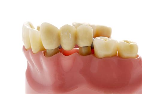 Dental Bridge Types Advantages Disadvantages