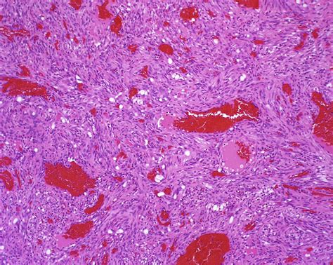 Histopathology Of Spindle Cell Vascular Tumors Surgical Pathology Clinics