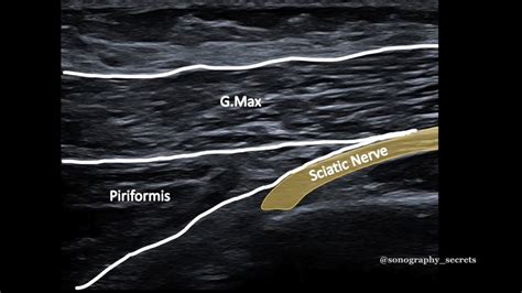 Piriformis On Ultrasound YouTube