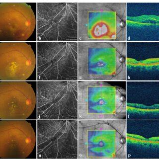 Multimodal Imaging Of The Affected Eye In Case A Fundus Photography