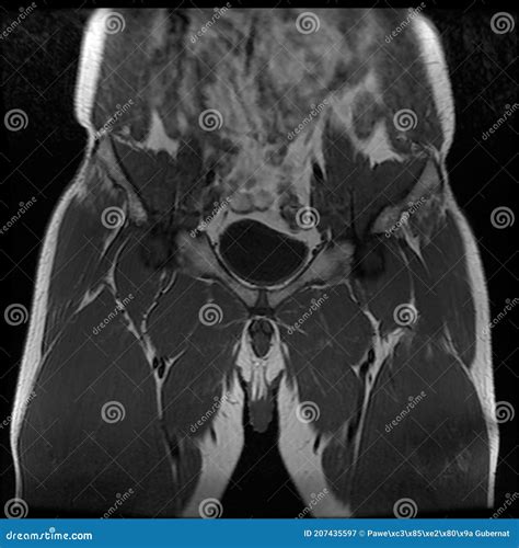Imagen De Resonancia Magnética De La Cadera Masculina Cambios Visibles