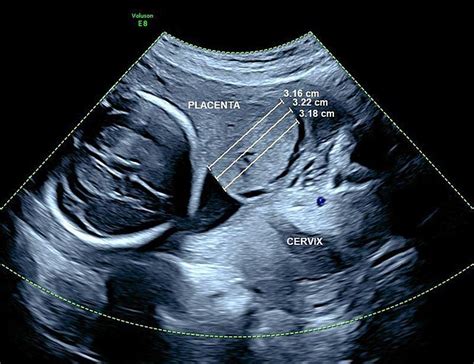 Mid Trimester Sonographic Placenta Previa Thickness And Persistence At Delivery European