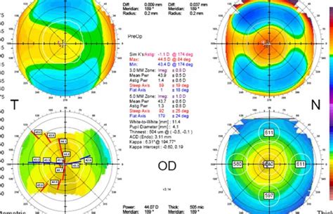 Qué aspectos considerar al interpretar resultados de topografía corneal