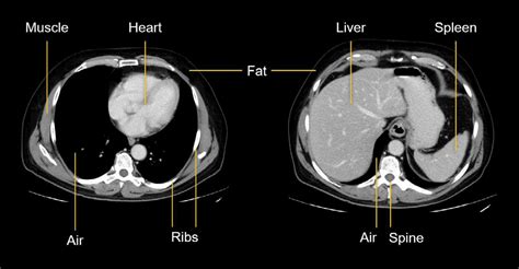 Labelled Female Ct Scan Abdomen at Rosario Miesner blog