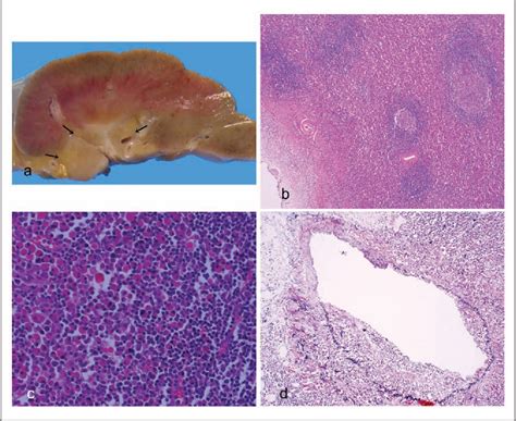 Figure 1 From Igg4 Related Disorder Of The Retroperitoneum Resembling Castleman’s Disease Plasma