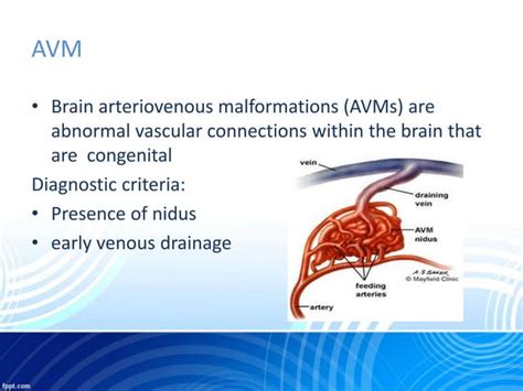 Dural Arteriovenous Fistula And Avm Ppt