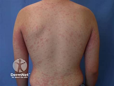 Urticaria And Urticaria Like Conditions