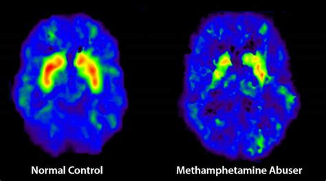 The Dangerous Effects Of Meth What Every Parent Needs To Know