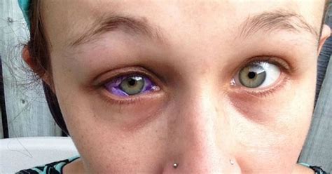 Sclera: Definition, Functioning, Associated Conditions and ...