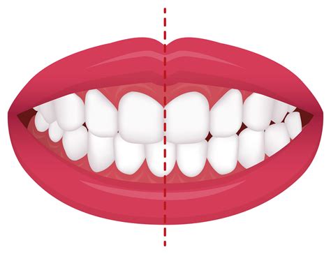 Correcting A Midline Misalignment – Roosevelt Dental Center