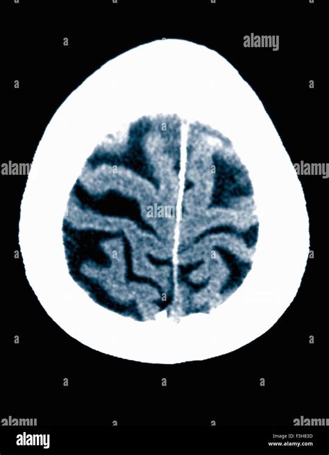 Alzheimer S Disease Brain Ct Scan