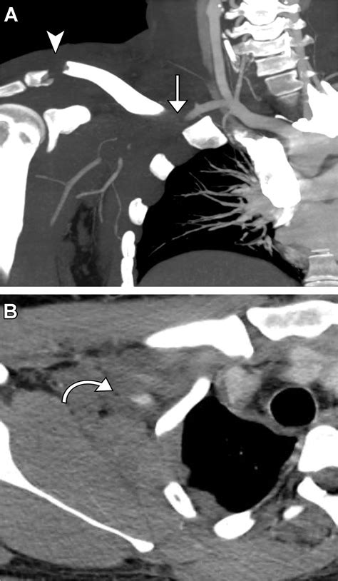 Subclavian Artery Anatomic Review And Imaging Evaluation Of Abnormalities Radiographics