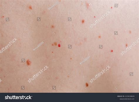 Close Large Moles On Naked Female Stock Photo 2176538629 Shutterstock
