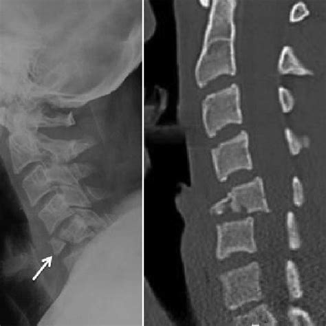 23 Sci Associated With A Flexion Teardrop Fracture Sagittal T1 And