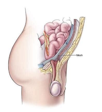 Liesbreukoperatie Via Kijkoperatie Abdominale Heelkunde Heelkunde