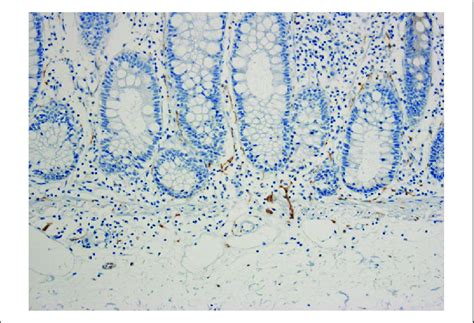 Positive Pattern Of Calretinin Immunohistochemistry There Is Positive