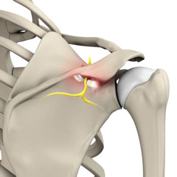 Suprascapular Nerve Release Monterey Shoulder Pain Salinas Rotator