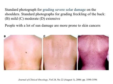 Melanoma What Does Skin Cancer Look Like Kimaja Farwani