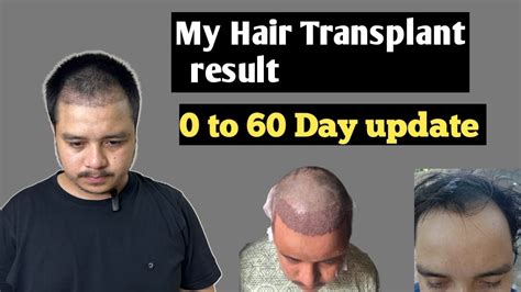 Hair Transplant In Nepal Day 60 My Hair Transplant Condition Update