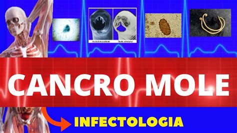 CANCRO MOLE CAUSAS SINTOMAS DIAGNÓSTICO E TRATAMENTO INFECTOLOGIA