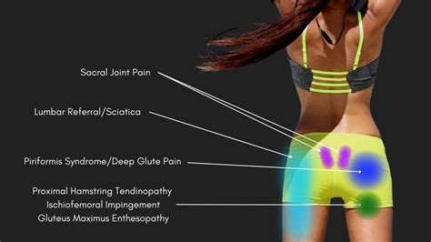 Back Pain Location Chart: Understanding Your Pain and Finding the Right ...