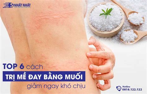 Các Phương Pháp Cách Trị Mề đay Bằng Muối Bạn Cần Biết