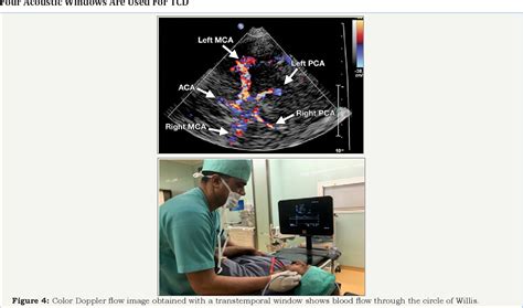 Figure 1 From Transcranial Doppler Tcd Ultrasonographyand Its