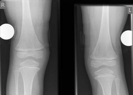 Viewing Playlist Lab Skeletal Dysplasias Radiopaedia Org