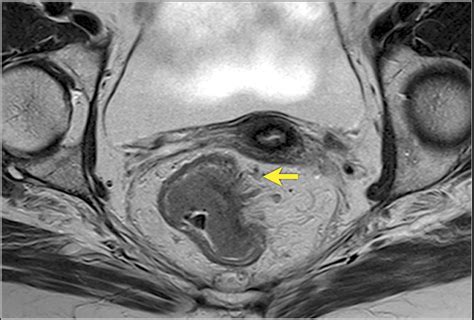 Rectal Cancer Home Remedies: Stage 3 C Rectal Cancer