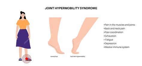 Premium Vector | Joint hypermobility poster 