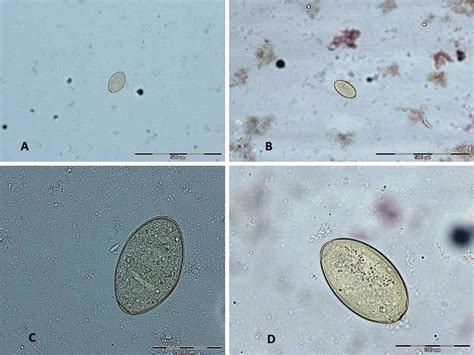 Ova of Fasciola in stool examination. A, B: With ×100 magnifications C